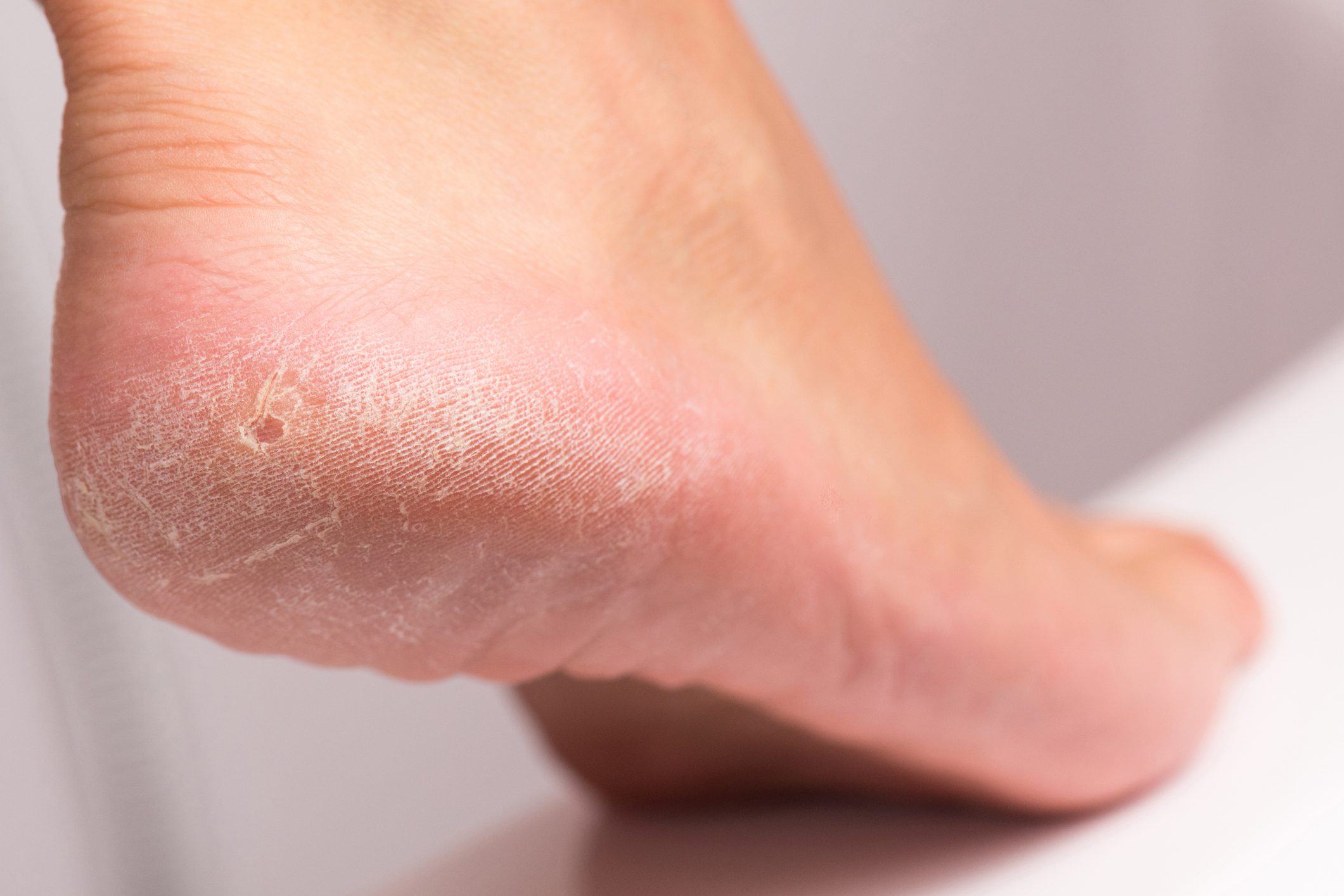 Hyperkeratosis - NailKnowledge